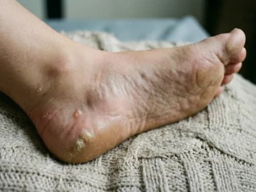 Piedi gonfi, calli e verruche